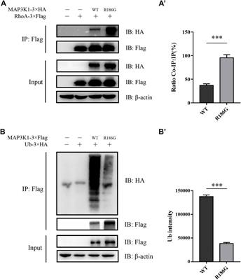 MAP3K1 Variant Causes Hyperactivation of Wnt4/β-Catenin/FOXL2 Signaling Contributing to 46,XY Disorders/Differences of Sex Development